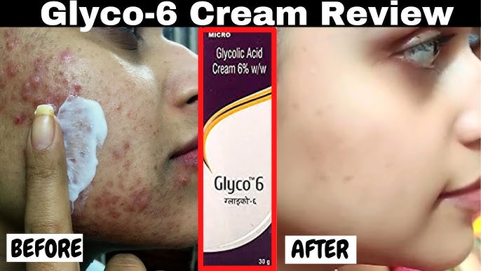 Glyco 6 Cream for Your Skin
